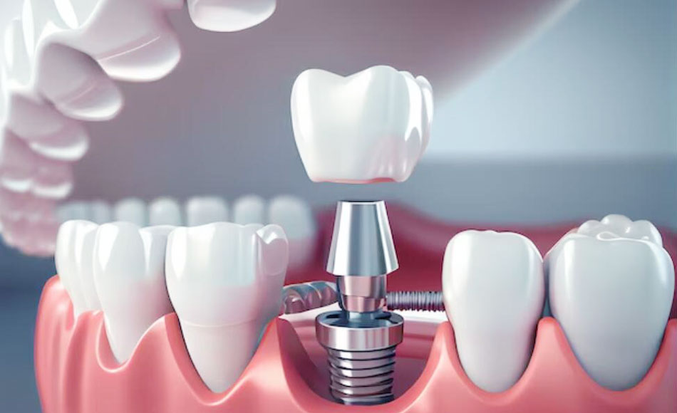 What are the components of dental implants?